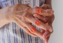 Chondroitin Wirkung Einnahme Nebenwirkungen