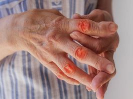 Chondroitin Wirkung Einnahme Nebenwirkungen