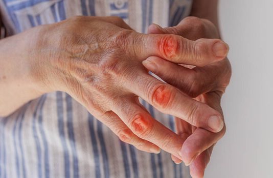 Chondroitin Wirkung Einnahme Nebenwirkungen